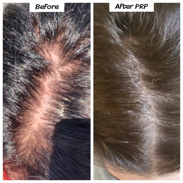 Platelet-Rich Plasma For Hair Loss